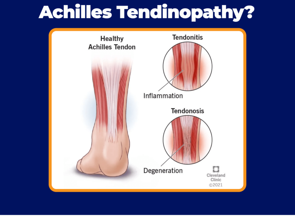 How to Prevent Achilles Injuries