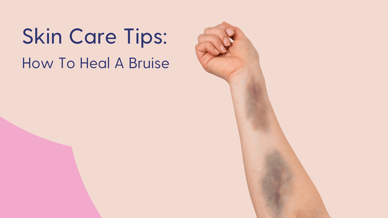 How to Prevent Bruising After Injury
