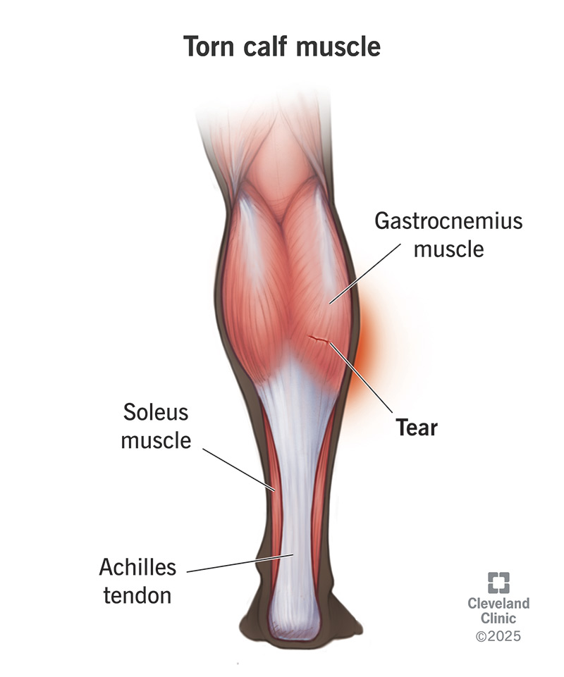 How to Prevent Calf Injury