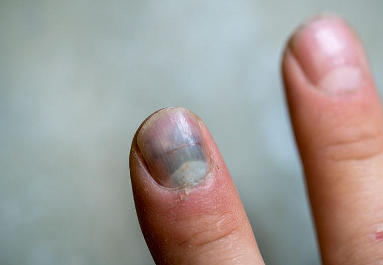 How to Prevent Nail from Falling off After Injury
