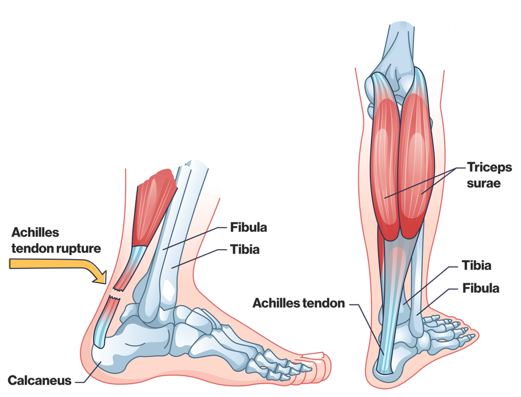 How to Prevent Pickleball Injuries in Boston